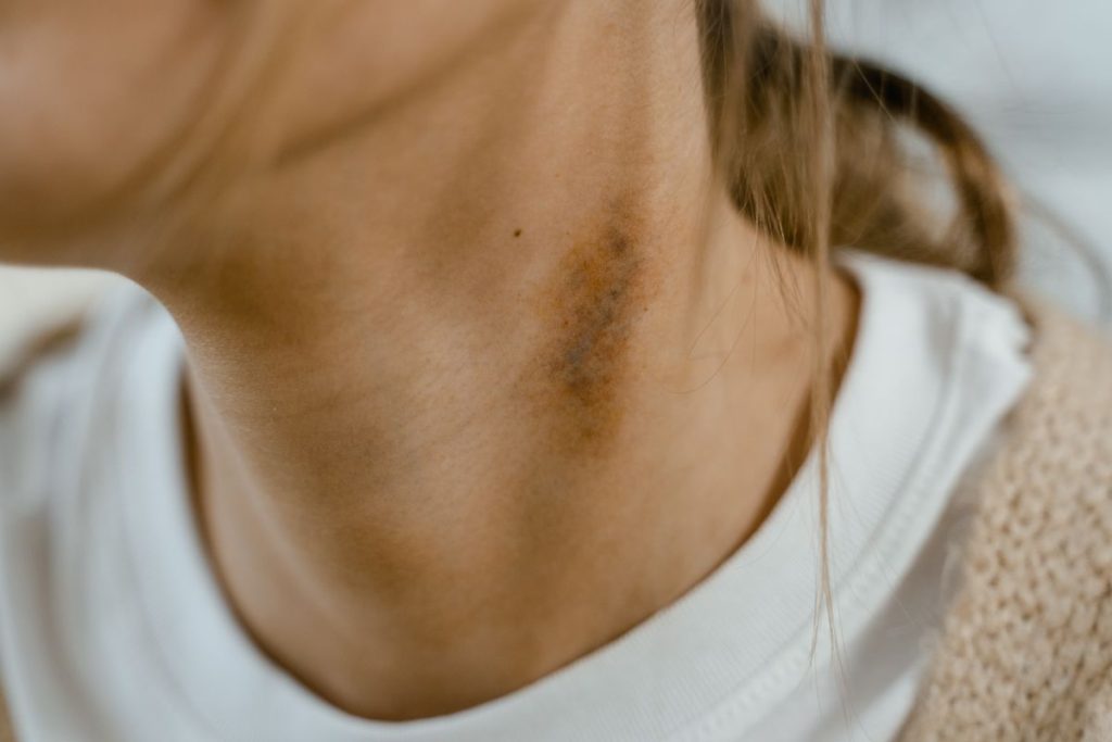 Hickey là gì? Bao lâu thì hết và cách làm mờ nhanh 1 Vết bầm đỏ trên cổ do hôn mút